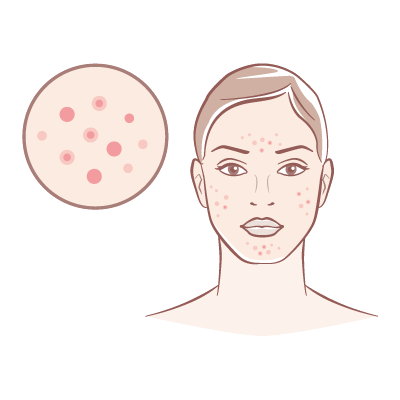 Acne Prone Skin