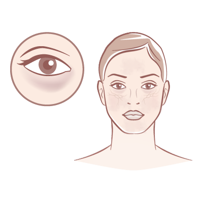 Dullness & Uneven Tone