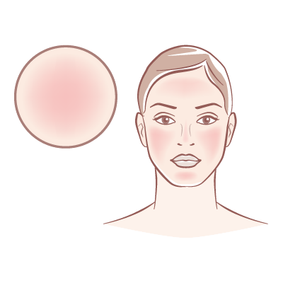 Redness & Rosacea