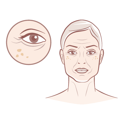 Fine Lines & Wrinkles